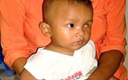 Những biểu hiện của bệnh ung thư mắt ở trẻ em